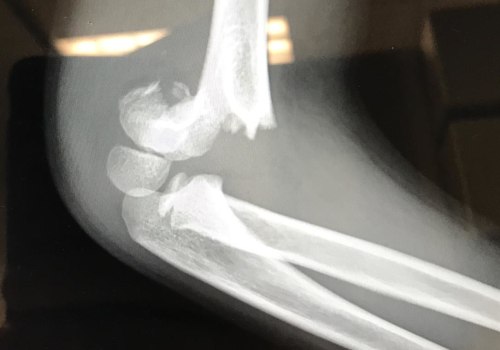 The Power of Nerve Transfers in Treating Brachial Plexus Injuries