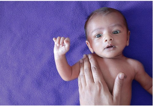 What are the causes of erb's palsy?